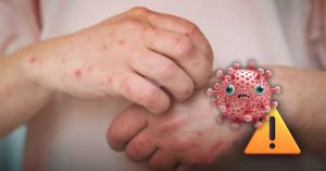 Sarampión y Mundial