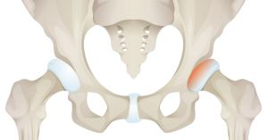 What the Acetabulum Can Teach Us About Marriage