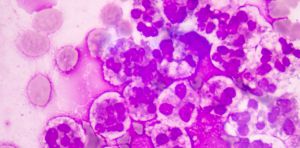 Why sepsis is becoming harder to treat in Europe