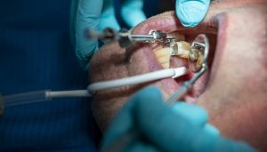 Tett hullet i velferdsstaten