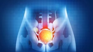 Prostat kanseri , Bölüm I-II