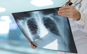 Tuberculosis remains the world’s deadliest infectious disease – Australia’s regional leadership matters