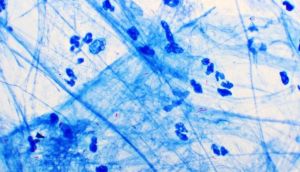 How a new blood test detects active, infectious Tuberculosis: Here’s everything to know