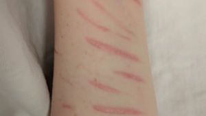 Paola, 19 anni, per mesi si è tagliata braccia e gambe: «Mi sentivo giudicata, quando mi ferivo stavo meglio»