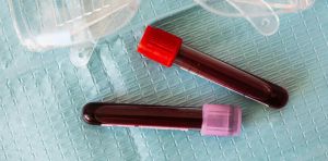 Treating previously untreatable cancers: How CAR‑T cell therapy could be made accessible to more patients