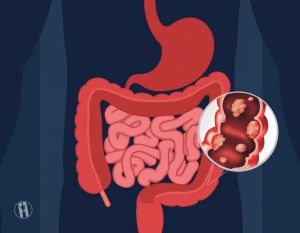 Avances recientes en el diagnóstico temprano del cáncer colorrectal