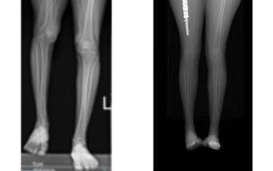 Israeli doctors use 3D printer to lengthen woman’s leg for vanishing bone disease