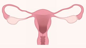 Da el paso y consulta: puede ser cáncer de ovario