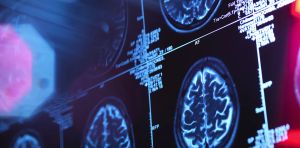 Blood biomarkers could detect earliest signs of Alzheimer’s disease – and slow its progression