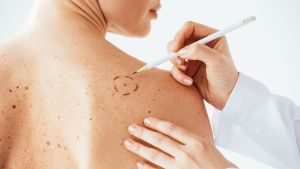 Melanoma, ecco quando bisogna fare una visita dermatologica. L’importanza dell’autoesame della pelle