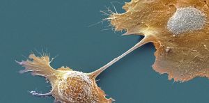 Breakthrough drug nearly doubles survival with advanced pancreatic cancer – an oncologist explains how daraxonrasib overcame an ‘undruggable’ disease