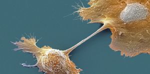 Cancer du pancréas : un médicament cible une protéine réputée « impossible à bloquer » et double les taux de survie