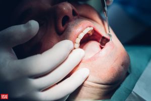Xerostomia: O problema silencioso da boca seca explicado por um dentista