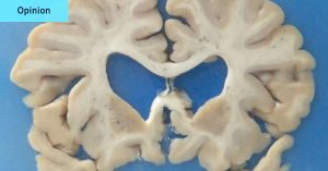 CTE is a frightening thing. But banning risky sports isn’t the answer