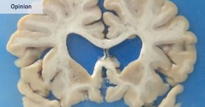 CTE is a frightening thing. But banning risky sports isn’t the answer