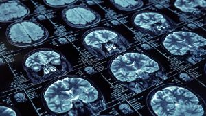 Stopping Cognitive Decline? Scientists Just Discovered the Protein Driving the Spread of Alzheimer’s