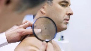 Melanoma, mancano i dermatologi: l’Usl pubblica un concorso