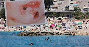 Splitom se širi neugodna zaraza: Djeca su najugroženija, sve ih je više po ambulantama