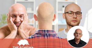 Finally, bald men like me have their day in the sun