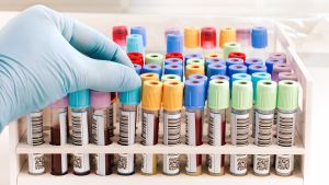 Cognitive Decline Can Start 20 Years Before Symptoms Appear. The FDA Just Cleared a Blood Test for Adults as Young as 40