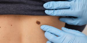 Así funciona a nivel molecular la nueva terapia contra el melanoma