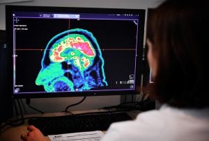 Première mondiale : une tumeur au cerveau retirée grâce à une IA en temps réel