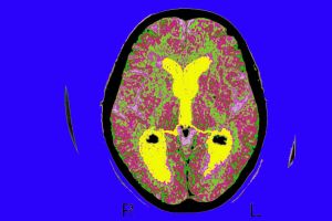 Alzheimer’s patients deserve to know their diagnosis