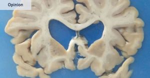 The data on contact sport, concussion and CTE is convincing. But not conclusive