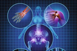 Arthrose : derrière l’usure, une inflammation causée par nos modes de vie