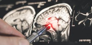La epilepsia es más común en países de bajos ingresos