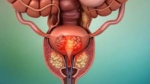 Doctor reveals hidden impact of prostate cancer treatment on intimacy