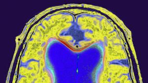 Tous les malades d’alzheimer ont les mêmes espoirs, mais pas le même accès aux médicaments