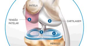 Artrose do joelho: entre o mito e a evidência