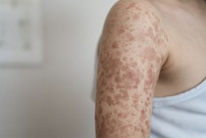 10 Simple Ways to Prevent Measles Infection as US Cases Climb to Worst Levels Since 1991, New CDC Figures Show