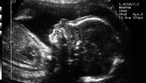 First-of-its-kind treatment shrinks unborn baby’s tumour before birth