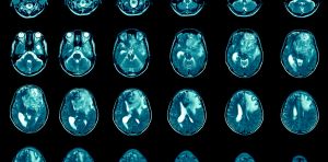 Melatonina: una aliada inesperada contra el tumor cerebral más agresivo