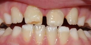 Manchas en los dientes: ¿por qué tantos niños las tienen?