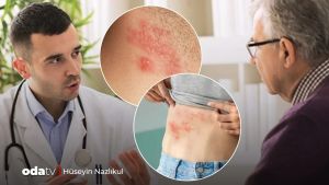 Zona hastalığı deriden önce konuşur