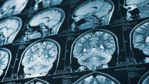 Your Aging Brain Isn’t Just Declining. Scientists Say Forgetting Details May Give It a Different Advantage